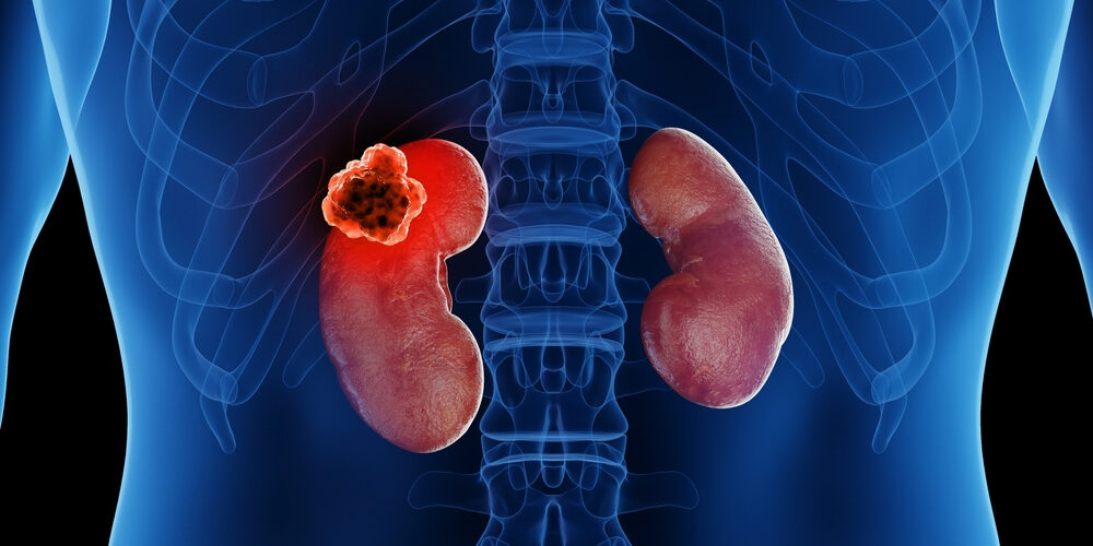 Kidney Cancer Image